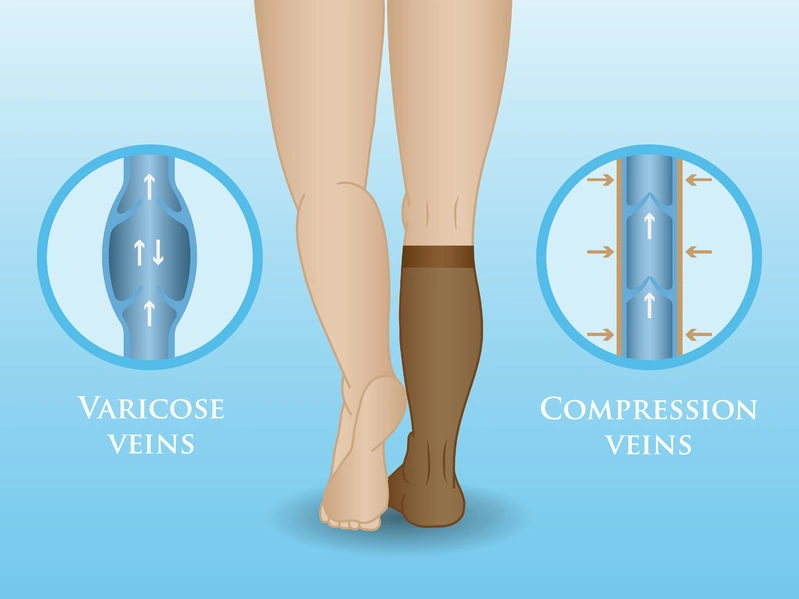 Can Compression Socks Help With Neuropathy